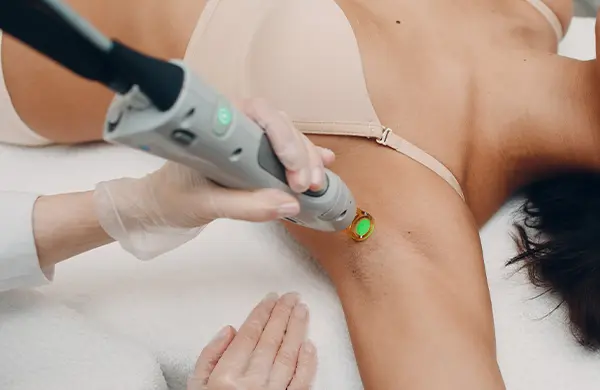 épilation laser de l'aisselle